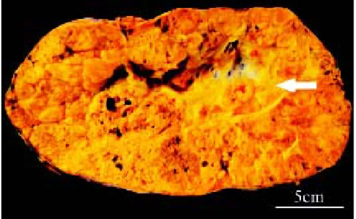 Figure 2. Gross image. The entire right lobe and one half of the left lobe is replaced by a 27cm multinodular tumour