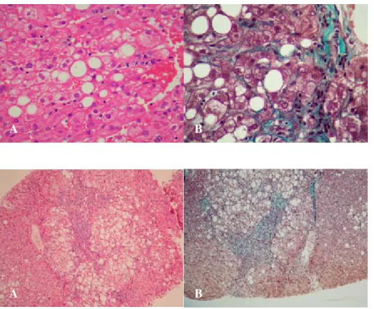 Figure 2A. Grade 2 steatohepati-