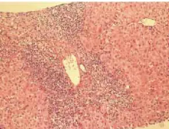 Figure 1. Interface hepatitis. Mononuclear inflammatory infiltrate dis- dis-rupts limiting plate of portal tract and extends into parenchymal  tis-sue