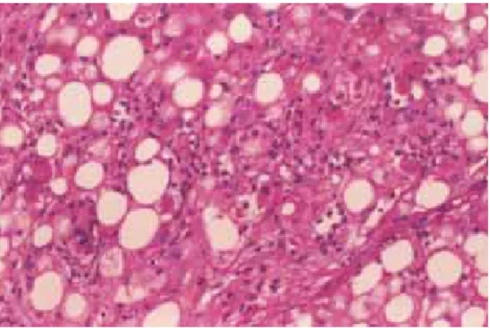 Figure 3. The hepatocellular fat is largely macrovesicular. The edge of