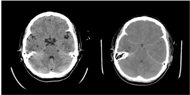 Figure 1.  Rapid development of brain edema in a patient with fulminant hepatic failure