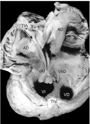 Fig. 2A.  Vista interior de la unión A-V que muestra una válvula común balanceada en  situs solitus 