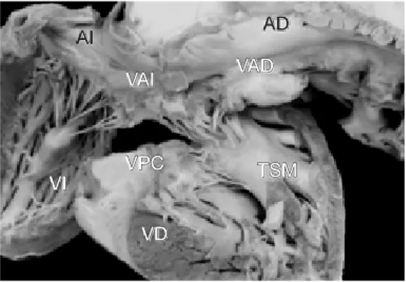 Fig. 5C.  Vista interna de los ventrículos y de la unión A-V con una válvula A-V común e inserción de las valvas anteriores sobre el cuerpo de la trabécula septomarginal