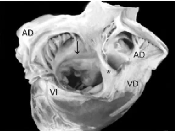Fig. 6B.  Vista interior de las cámaras derechas de un corazón con DSA-V que muestra dos válvulas atrioventriculares