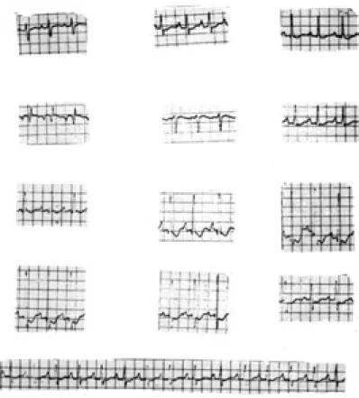 Fig. 3.  ECG de una paciente con cor pulmonale crónico de origen vascular