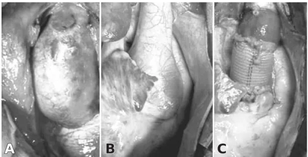 Tabla I.  Dentro de las patologías que se asocian con dilatación de la aorta se encuentran: