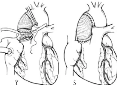 Fig. 6.  En esta figura se aprecia la resolución de los aneurismas de aorta ascendente supracoronarios