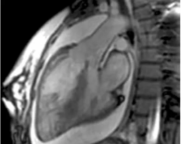 Fig. 8.  Atresia tricuspídea. Se define la banda fibrosa conformada por el piso del atrio derecho, la amplia comunicación interauricular y estrecha comunicación ventricular con ventrículo derecho hipoplásico.