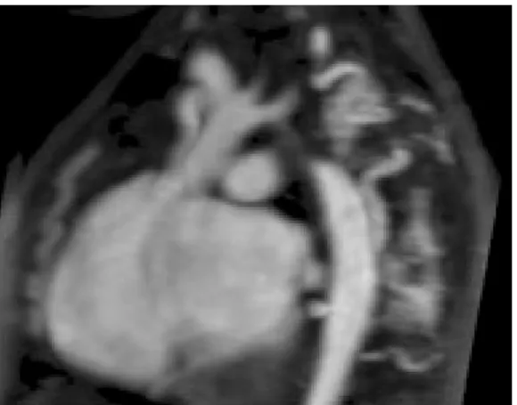 Fig. 19.  Dilatación sinotubular en Marfan.