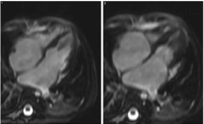 Fig. 23.  Miocardiopatía hipertrófica septal.