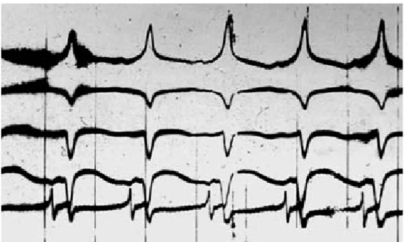 Fig. 6. El signo de la preexcitación: inscripción de la onda delta en la porción inicial de las ondas R, se manifiesta tras la administración, por vía venosa, de 12 mg de inosina en el curso de una taquicardia ventricular experimental con frecuencia de 273