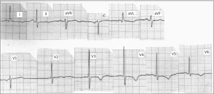 Fig. 1. Surface 12-leads electrocardiogram showing sinusal rhythm, AQRS F  +4°, PR 165 msec, T-axis 125°, PR 157 msec, QRS 82 msec, QTc 394 msec, intrinsecoid deflection time inscription in V6 38 msec