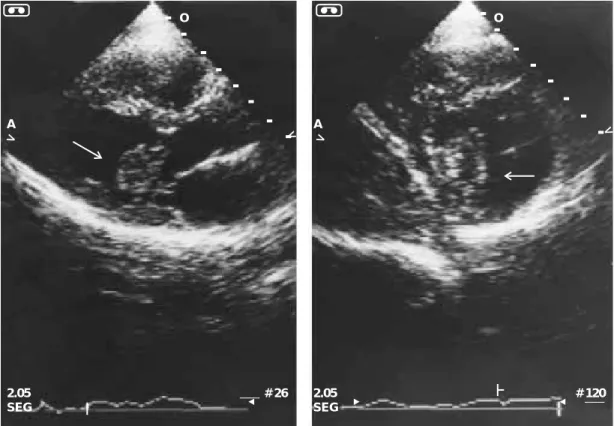 Fig. 1. Ecocardiograma. A la izquierda un eje largo paraesternal en donde se aprecia una masa dentro de la cavidad ventricular izquierda en relación con el aparato subvalvular mitral (flecha)