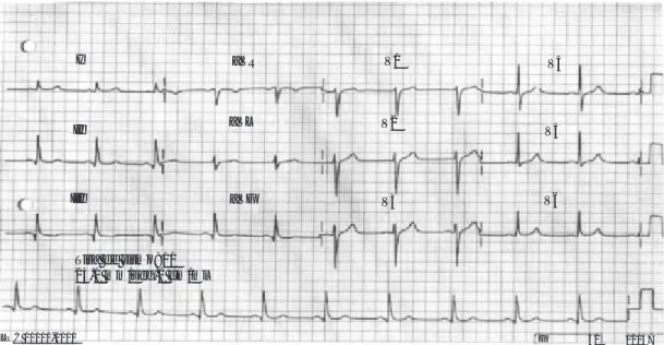 Fig. 3. Ingresa masculino de 50 años de edad, con dolor precordial, sin antecedentes previos de cardiopatía