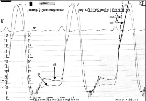 Fig. 12.  Alteración de la interrelación normal de presiones. Paciente con hipertensión arterial pulmonar primaria grave: el aumento severo de la presión sistólica del VD iguala la presión del VI
