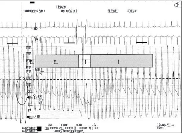 Fig. 13.  Maniobra de Valsalva normal en estenosis aórtica severa con función ventricular normal