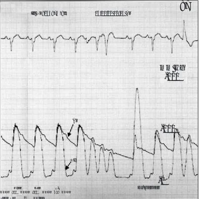 Fig. 4.  Valor diagnóstico de una arritmia. Registro si- si-multáneo de presiones de VI y Ao en paciente con miocardiopatía hipertrófica obstructiva
