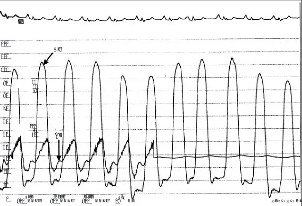Fig. 7.  Restricción ventricular: ejemplos de miocardiopatía restrictiva asimétrica. A, restricción asimétrica del VI: la presión del VI al inicio de la diástole desciende a 13 mm Hg y bruscamente alcanza su valor máximo (imagen “en raíz cuadrada”)