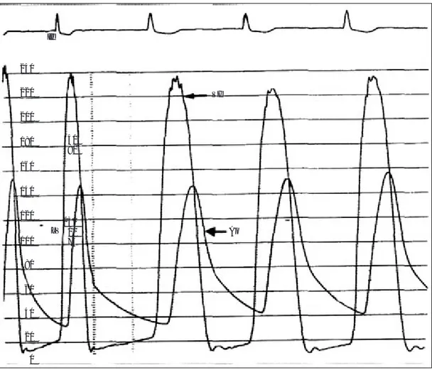Fig. 8.  Doble lesión aórtica: registro simultáneo en VI y Ao. Además del gradiente sistólico de 83 mm Hg indicativo de estenosis aórtica severa, el trazo de aorta carece de incisura y la presión diastólica desciende hasta 40 mm Hg por la insuficiencia val