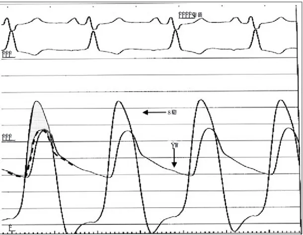 Fig. 9.  Estenosis aórtica: registro simultáneo de presiones en VI y Ao. La diferencia de presión sistólica máxima entre aorta y ventrículo de 39 mm Hg (“gradiente pico-a-pico”) sugiere estenosis leve, sin embargo, en este paciente con gasto cardíaco reduc