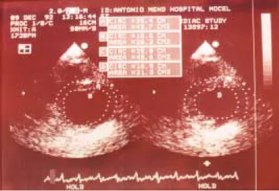 Tabla VI. Hipertrofia ventricular izquierda en insuficien-