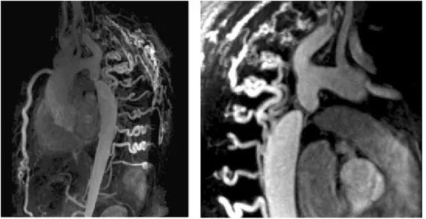 Fig. 7. A. Secuencia eco de gradiente en dos cámaras en la que se observa dilatación aneurismática apical del