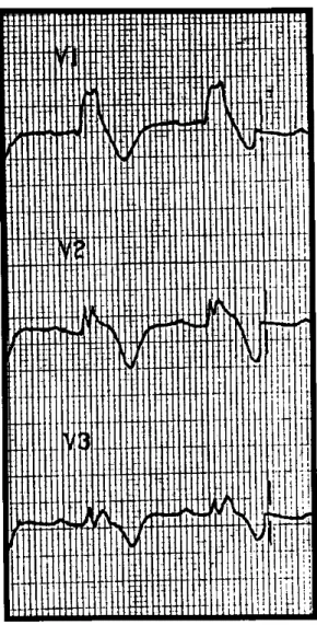 Fig. 3. Electrocardiograma de superficie donde se ob- ob-servan tres derivaciones V 1 , V 2  y V 3 , que muestran una imagen de bloqueo de rama derecha del haz de His con elevación del segmento RST, más acentuado en V 2 .