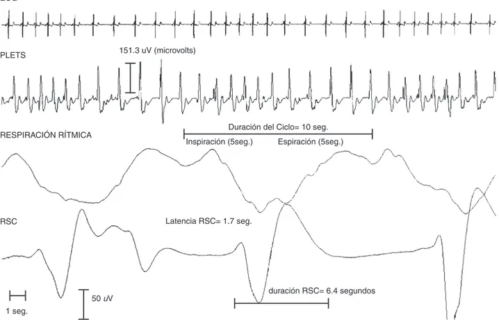 Fig. 4. Esta figura es una muestra de la maniobra de respiración rítmica a 6 ciclos por minuto