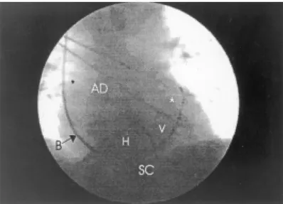 Fig. 2. Imagen fluoroscópica en proyección posteroanterior que muestra la