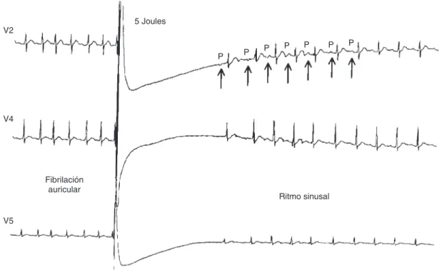 Fig. 4. Registro electrocardiográfico e intracavitario que muestra la interrupción de la fibrilación atrial después de