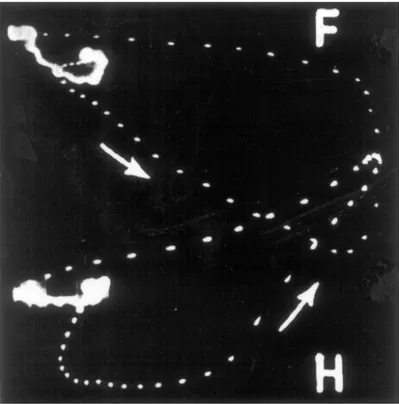 Fig. 1B. El vectocardiograma preoperatorio muestra igualmente signos de crecimiento biventricular: gran amplitud del asa Q H  y voltaje acentuado del vértice del asa R H 