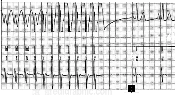 Fig. 1. Taquicardia ventricular monomórfica sostenida con la frecuencia de 166 lpm registrada por el DAI e inte-