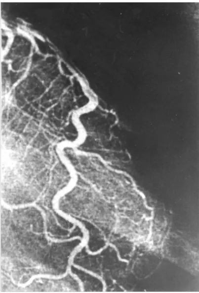 Fig. 14. Arteriografía coronaria. Patrón angiográfico que corresponde en la circulación distal a TIMI 3M.
