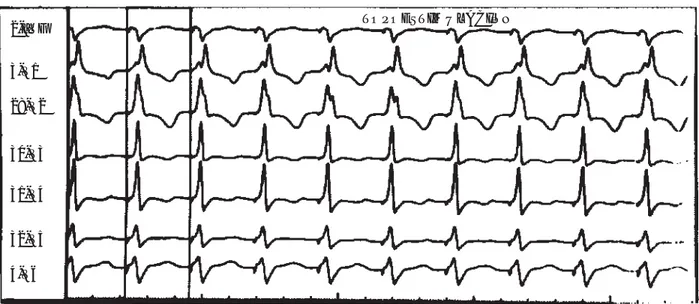 cuadro electrocardiográfico es semejante al de un BRDHH acentuado.
