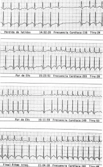 FIG. 1: Monitoreo Holter de 24 horas en el que se obser- obser-van episodios frecuentes de fibrilación auricular con  res-puesta ventricular rápida, algunos latidos conducidos con aberrancia alternando con taquicardia auricular ectópica, con una frecuencia