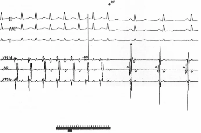 FIG. 7: Al introducir el catéter de ablación dentro de la vena pulmonar superior izquierda (VPSI), se observó una deflexión auricular desdoblada de menor amplitud con 80 mseg de precocidad