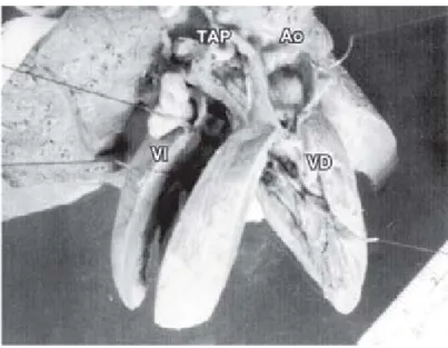 Tabla II. Conexiones ventriculoarteriales.
