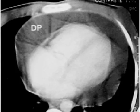 Fig. 3. TC con medio de contraste de tórax, corte