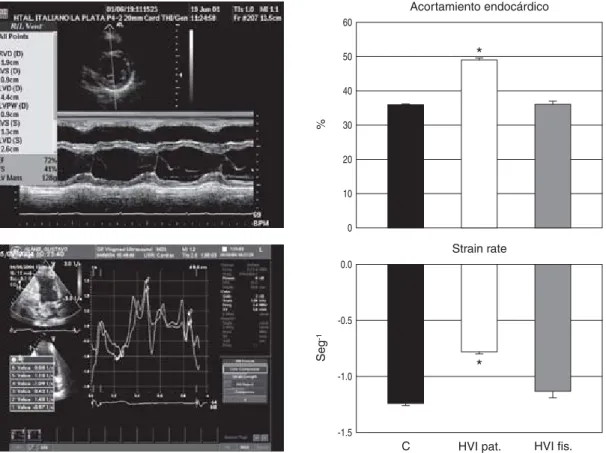 Fig. 12. Cuando analizamos en humanos el acortamiento de las fibras longitudinales del ventrículo izquierdo mediante un estudio ecocardiográfico utilizando strain-rate, se observó una disminución de la contracción en corazones hipertróficos por hipertensió