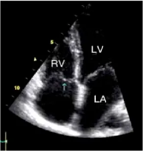 Fig. 4. (a) Parasternal long axis image shows prolapse of the noncoronary leaflet of the aorta (arrow)