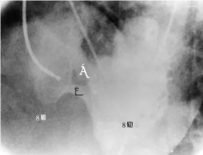 Fig. 4. Ventriculografía izquierda en posición cuatro cámaras, posterior a