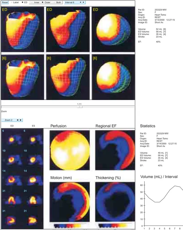 Fig. 2. Imágenes del estudio de Gated-Spect donde se aprecia incremento de la densidad a nivel del ápex del VI y una pequeña zona de hipoquinesia a nivel apico-septal sin presencia de aneurisma reflejada igualmente en el mapa polar de motilidad.