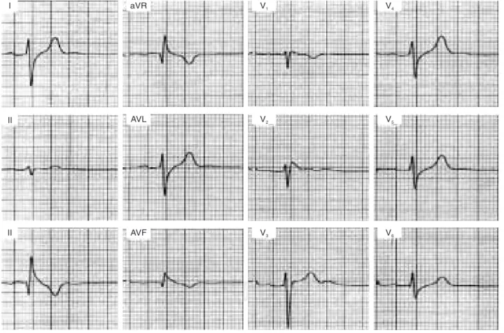 Fig. 1. Electrocardiograma de 12 derivaciones, donde se observa un cuadro electrocardiográfico del “síndrome de Brugada” con la