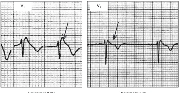 Fig. 5. Un acercamiento de la derivación V 1  al minuto 0’.05” de la recuperación y al minuto 3’.00”