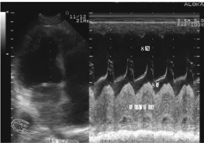 Fig. 3. Vista apical en modo M donde se observa la gran densidad de ecos a nivel de la aurícula izquierda y la proximidad del tumor a la válvula