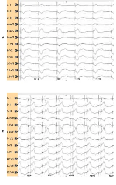 Fig. 3C. Cuando realizamos estimulación biventricular