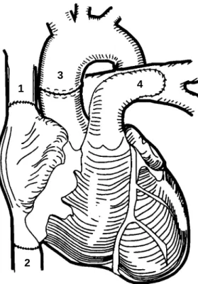 Fig. 1. La técnica de trasplante. Los números 1 y 2 señalan la anastomosis bicaval, el número 3 la doble sutura de la anastomosis aórtica, y el número 4 indica la prolongación de la anastomosis sobre la rama  iz-quierda de la arteria pulmonar del receptor