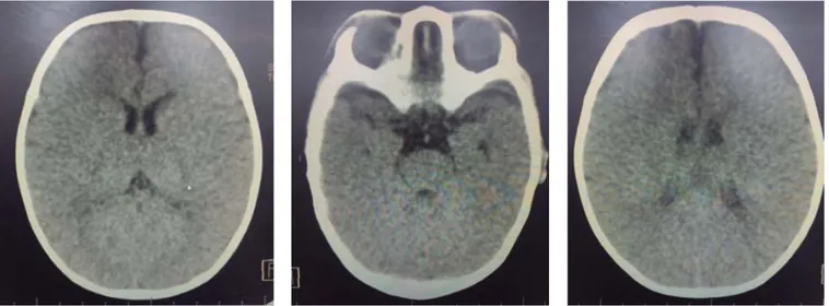 Figura 3.  Tomografía de cráneo simple sin alteraciones, no se observan calciﬁ caciones periventriculares.