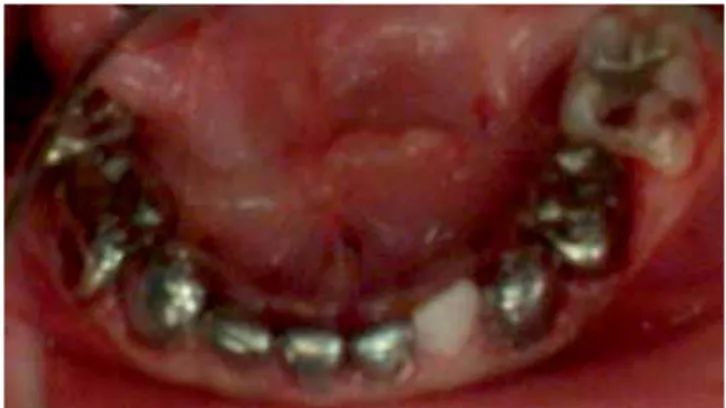 Cuadro III. diagnósticos y tratamientos de los órganos dentales del paciente con síndrome de Escobar.