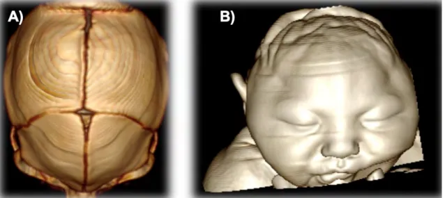 Figura 8.  Imagen en 3D A) Alteración morfológica de los huesos de la bóveda craneal, hipoplasia de huesos fronto-parietal  bilateral, sobre posición suturas, coronal, sagital escamosas y lambdoidea